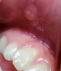 口の中 下唇 にできた痛みのない水ぶくれの経過 ほぼ消えたので粘液嚢胞っぽい