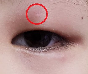 目の腫れ まぶた と耳の腫れで眼科と皮膚科を受診 アレルギーか虫刺されか