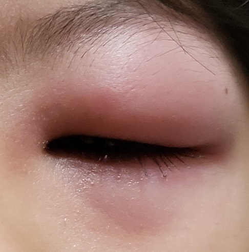 目の腫れ まぶた と耳の腫れで眼科と皮膚科を受診 アレルギーか虫刺されか